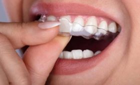 Choosing Invisalign or Clear Aligners for Teens and Adults Expert Guide