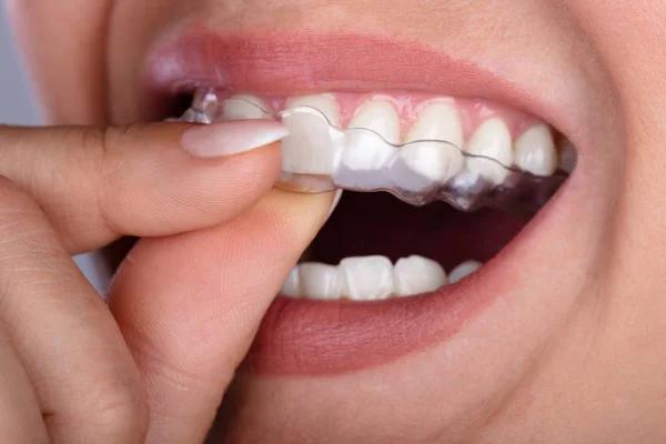 Choosing Invisalign or Clear Aligners for Teens and Adults Expert Guide